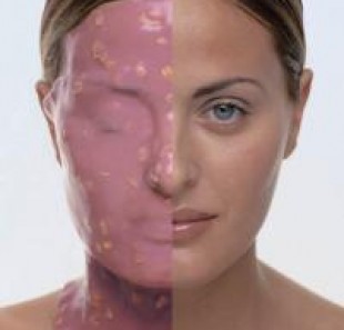 SENSITIVE MASK-Hassas ve Kuperozlu Ciltler için Maske